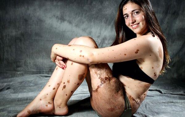 девушка с 500 родинками, Альба Парехо, Alba Parejo