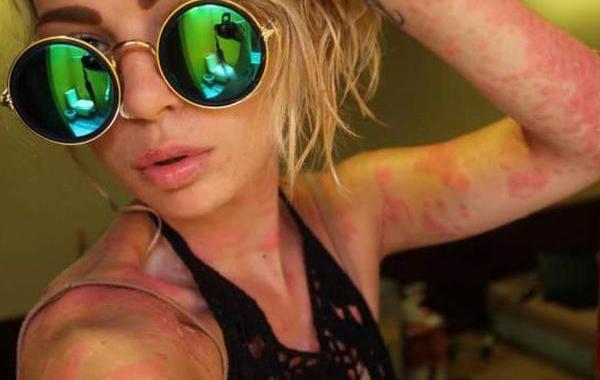 девушка псориаз бикини,  Джорджия Ланузза, Giorgia Lanuzza, показала своё тело псориаз, тело девушки псориаз