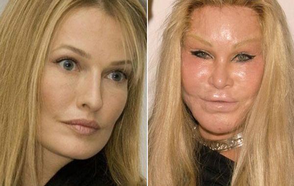 неудачные пластические операции звёзд, звёзды с неудачной пластикой