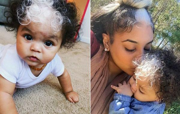 девочка родилась с белой прядкой волос, MilliAnna