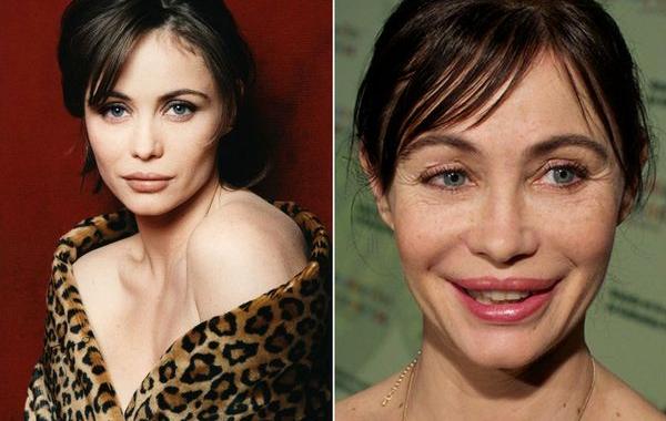 неудачные пластические операции звёзд, звёзды с неудачной пластикой