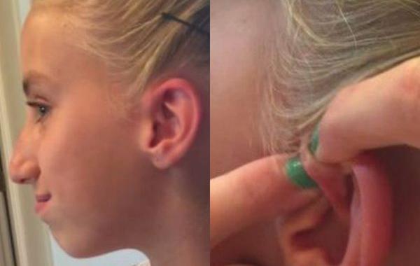 выдавила прыщ выращивала 6 лет, выдавила шестилетний прыщ, девочка выдавила прыщ шесть лет