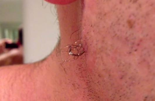 самый длинный вросший волос, извлечение самого длинного вросшего волоса, парень достал из лица самый длинный вросший волос