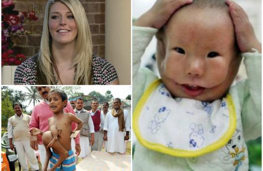 9 историй о людях, родившихся с лишними частями тела